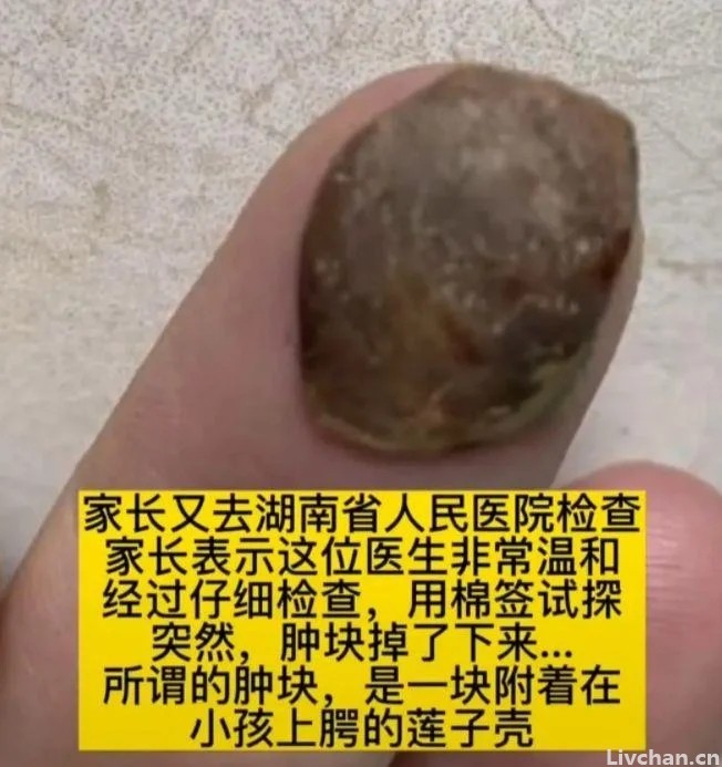 湘雅40年资历名医把莲子壳看成肿瘤？张煜医生揭秘内幕