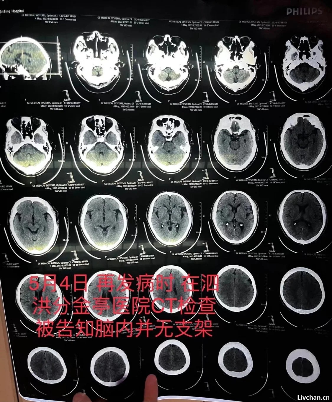 患者因脑梗去世，医生承认此前未成功植入脑血管支架并隐瞒