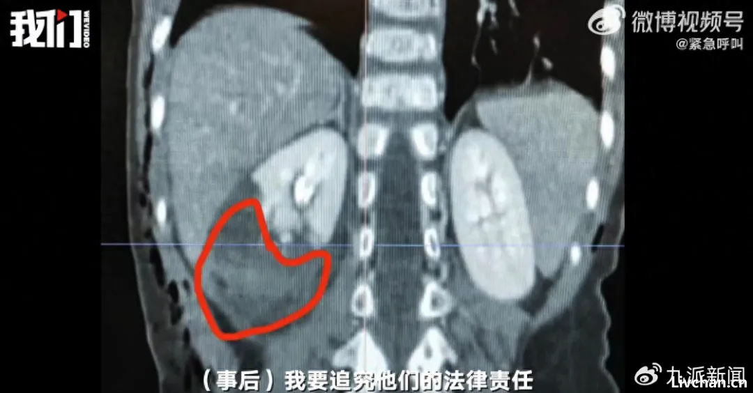 成都女童被恶犬咬伤事件:小孩丢肾的概率非常高,呼吁立法入刑