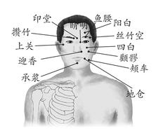 面瘫