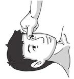 面瘫