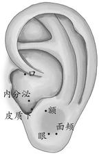 面瘫