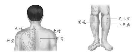 慢性阑尾炎