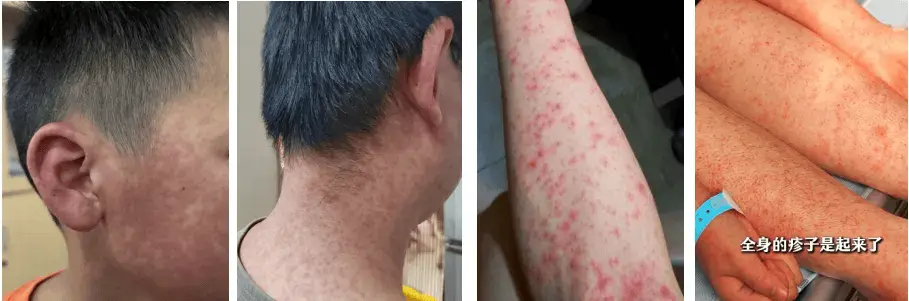 实探基孔肯雅热三级响应镇：医疗资源充足，基层防疫任务重
