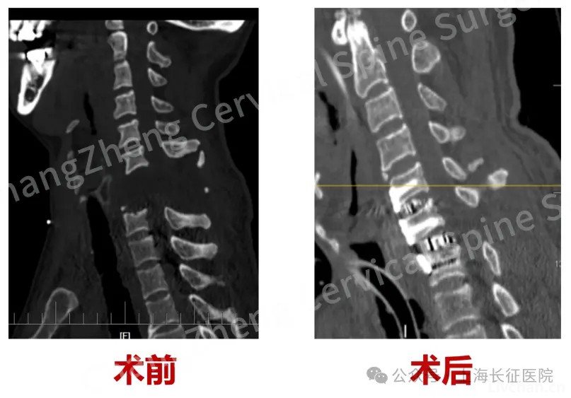 全球罕见！医生救回“身首离断”患者