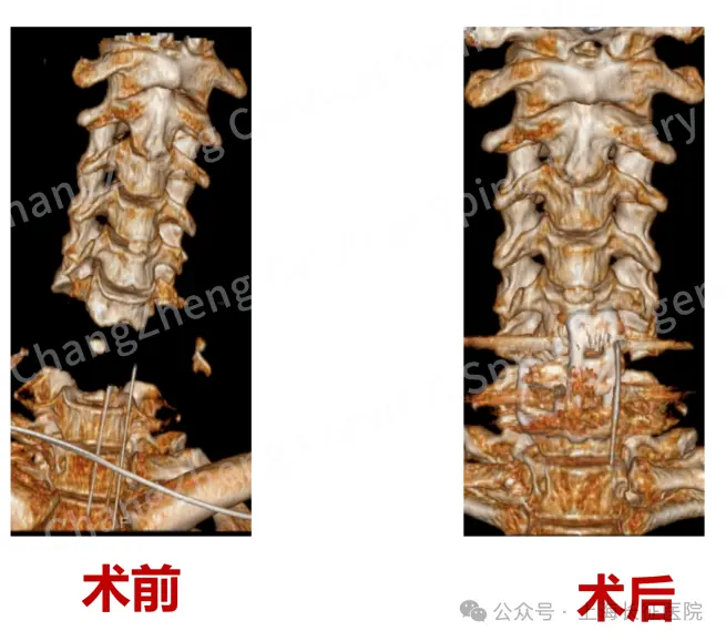 全球罕见！医生救回“身首离断”患者