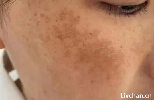 脸上有这8种症状,说明你的脾胃正在求救! 脸上有这8种症状,说明你的脾胃正在求救!